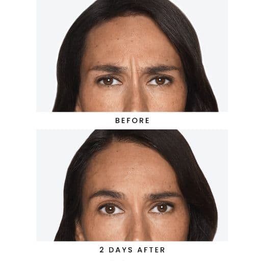 Elimina las arrugas del entrecejo Botox Daxxify